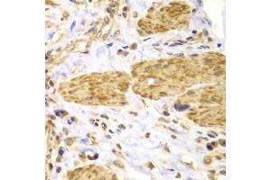 Immunohistochemistry of paraffin-embedded human gastric cancer using PTK2 antibody (ABIN5971141) at dilution of 1/100 (40x lens). (FAK antibody)