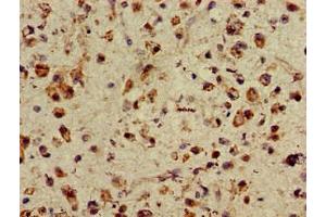 Immunohistochemistry of paraffin-embedded human glioma using ABIN7155470 at dilution of 1:100 (ASH1L antibody  (AA 1906-2160))