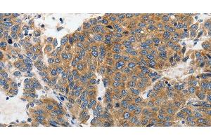Immunohistochemistry of paraffin-embedded Human liver cancer tissue using GluR2 Polyclonal Antibody at dilution 1:70 (GRIA2 antibody)