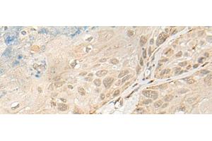 Immunohistochemistry of paraffin-embedded Human esophagus cancer tissue using OTX1 Polyclonal Antibody at dilution of 1:30(x200) (OTX1 antibody)