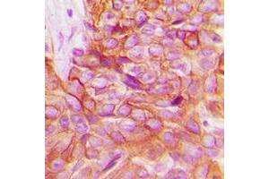 Immunohistochemical analysis of Alpha-adducin staining in human breast cancer formalin fixed paraffin embedded tissue section. (alpha Adducin antibody  (C-Term))