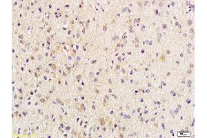 Formalin-fixed and paraffin embedded human brain glioblastoma labeled with Anti-Phospho-Beta-Catenin (Thr41/Ser45) Polyclonal Antibody, Unconjugated (ABIN683953) at 1:200 followed by conjugation to the secondary antibody and DAB staining (beta Catenin antibody  (pSer45, pThr41))