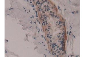 Detection of RPS6Ka1 in Human Breast cancer Tissue using Polyclonal Antibody to Ribosomal Protein S6 Kinase Alpha 1 (RPS6Ka1) (RPS6KA1 antibody  (AA 62-321))