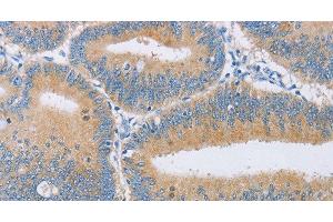 Immunohistochemistry of paraffin-embedded Human colon cancer tissue using CENPE Polyclonal Antibody at dilution 1:50