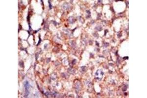 IHC analysis of FFPE human breast carcinoma tissue stained with the RIPK4 antibody (RIPK4 antibody  (AA 802-832))