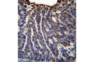 immunohistochemistry analysis in formalin fixed and paraffin embedded human ovarian carcinoma reacted with HOXB3 / HOX2G Antibody (Center) followed  which was peroxidase-conjugated to the secondary antibody, followed by DAB staining. (HOXB3 antibody  (Middle Region))