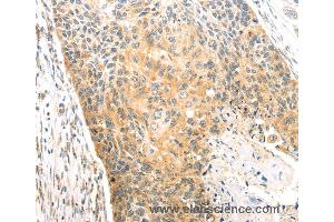 Immunohistochemistry of Human esophagus cancer using CAPN1 Polyclonal Antibody at dilution of 1:20