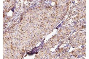 ABIN6278011 at 1/100 staining Human breast cancer tissue by IHC-P.