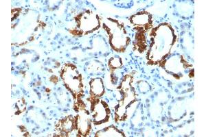 Formalin-fixed, paraffin-embedded human Renal Cell Carcinoma stained with Milk Fat Globule Monoclonal Antibody (EDM45) (MFGE8 antibody)