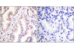 Immunohistochemistry analysis of paraffin-embedded human lung carcinoma tissue, using PIAS1 Antibody. (PIAS1 antibody  (AA 10-59))