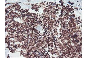 Immunohistochemical staining of paraffin-embedded Adenocarcinoma of Human breast tissue using anti-FMR1 mouse monoclonal antibody. (FMR1 antibody  (AA 36-279))