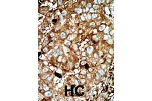 Formalin-fixed and paraffin-embedded human cancer tissue reacted with the primary antibody, which was peroxidase-conjugated to the secondary antibody, followed by AEC staining. (PFKFB3 antibody  (C-Term))