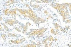 Immunohistochemistry of paraffin embedded human breast cancer using Epl4 (ABIN7073843) at dilution of 1:2000 (400x lens) (EFNA4 antibody)