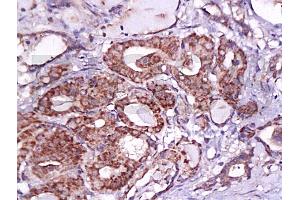 Formalin-fixed and paraffin embedded human thyroid carcinoma labeled Anti-B7H4 Polyclonal Antibody, Unconjugated (ABIN671736) at 1:200, followed by conjugation to the secondary antibody and DAB staining (VTCN1 antibody  (AA 50-100))