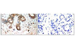 Immunohistochemical analysis of paraffin-embedded human breast carcinoma tissue, using 14-3-3 ζ (Phospho-Ser58) antibody (E011181). (14-3-3 zeta antibody  (pSer58))
