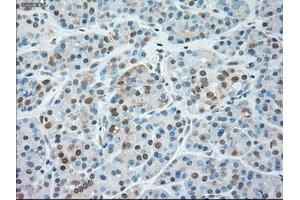 Immunohistochemical staining of paraffin-embedded Carcinoma of liver tissue using anti-SIGLEC9mouse monoclonal antibody. (SIGLEC9 antibody)