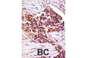 Formalin-fixed and paraffin-embedded human cancer tissue reacted with the primary antibody, which was peroxidase-conjugated to the secondary antibody, followed by DAB staining. (USP13 antibody  (AA 389-419))
