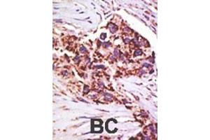 Formalin-fixed and paraffin-embedded human cancer tissue reacted with the primary antibody, which was peroxidase-conjugated to the secondary antibody, followed by DAB staining. (USP13 antibody  (AA 389-419))