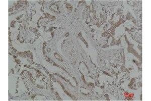 Immunohistochemistry (IHC) analysis of paraffin-embedded Human Breast Carcinoma using MEK-5 Polyclonal Antibody. (MAP2K5 antibody)