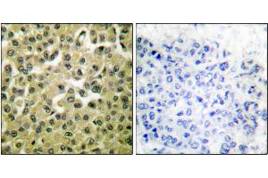 Immunohistochemical analysis of paraffin-embedded human breast carcinoma tissue using MCL1 antibody. (MCL-1 antibody)