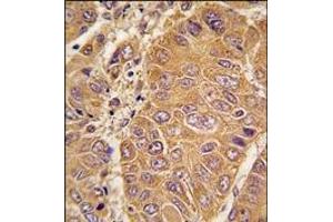 Formalin-fixed and paraffin-embedded human hepatocarcinoma tissue reacted with APOA1 antibody (N-term), which was peroxidase-conjugated to the secondary antibody, followed by DAB staining.