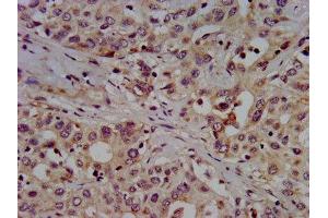 IHC image of ABIN7155172 diluted at 1:500 and staining in paraffin-embedded human liver cancer performed on a Leica BondTM system. (SLC7A1 antibody  (AA 430-492))