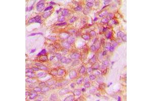 Immunohistochemical analysis of JAK1 staining in human breast cancer formalin fixed paraffin embedded tissue section. (JAK1 antibody  (C-Term))