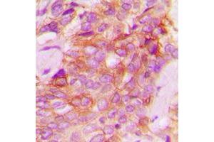 Immunohistochemical analysis of JAK1 staining in human breast cancer formalin fixed paraffin embedded tissue section.
