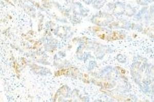 Immunohistochemistry analysis of paraffin-embedded Human ovarian cancer using Collagen X (ABIN7073549) at dilution of 1: 2000 (COL10 antibody)
