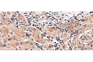 Immunohistochemistry of paraffin-embedded Human liver cancer tissue using INSC Polyclonal Antibody at dilution of 1:65(x200) (INSC antibody)