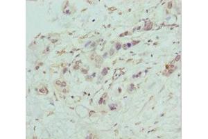 Immunohistochemistry of paraffin-embedded human pancreatic cancer using ABIN7148459 at dilution of 1:100 (COG5 antibody  (AA 1-260))