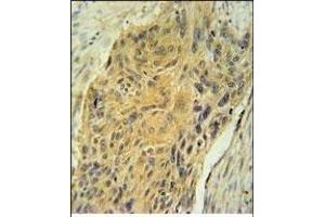AVP Antibody (Center) (ABIN651748 and ABIN2840385) immunohistochemistry analysis in formalin fixed and paraffin embedded human lung carcinoma followed by peroxidase conjugation of the secondary antibody and DAB staining. (Vasopressin antibody  (AA 102-129))