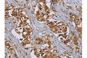 The image on the left is immunohistochemistry of paraffin-embedded Human breast cancer tissue using ABIN7192079(PUS10 Antibody) at dilution 1/45, on the right is treated with synthetic peptide. (PUS1 antibody)