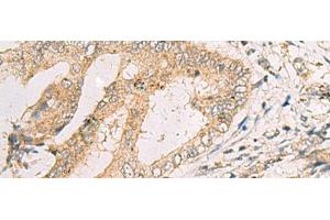Immunohistochemistry of paraffin-embedded Human cervical cancer tissue using SPACA1 Polyclonal Antibody at dilution of 1:50(x200) (SPACA1 antibody)