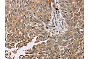 The image on the left is immunohistochemistry of paraffin-embedded Human lung cancer tissue using ABIN7130575(PDLIM7 Antibody) at dilution 1/35, on the right is treated with fusion protein. (PDLIM7 antibody)