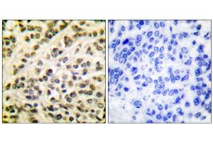 Immunohistochemical analysis of paraffin-embedded human breast carcinoma tissue, using FLI1 antibody (ABIN5976400). (FLI1 antibody  (Internal Region))