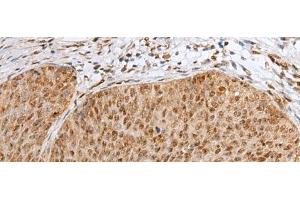 Immunohistochemistry of paraffin-embedded Human cervical cancer tissue using ZNF354A Polyclonal Antibody at dilution of 1:40(x200)
