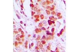 Immunohistochemical analysis of DDX52 staining in human breast cancer formalin fixed paraffin embedded tissue section.