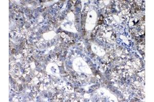 IHC testing of FFPE human liver cancer tissue with HER2 antibody at 1ug/ml.