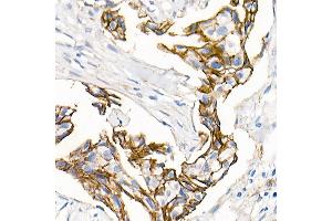 Immunohistochemistry of paraffin-embedded Human breast ductal carcinoma using δ-Catenin/p120 Catenin antibody (ABIN7266144) at dilution of 1:500 (40x lens). (CTNND1 antibody)