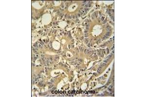 TPSD1 antibody (C-term) (ABIN654457 and ABIN2844191) immunohistochemistry analysis in formalin fixed and paraffin embedded human colon carcinoma followed by peroxidase conjugation of the secondary antibody and DAB staining. (TPSD1 antibody  (C-Term))