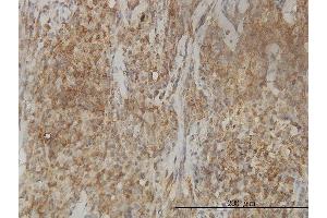Immunoperoxidase of monoclonal antibody to CAB39L on formalin-fixed paraffin-embedded human lymphoma tissue. (CAB39L antibody  (AA 1-337))