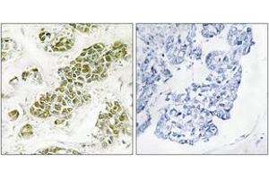 Immunohistochemistry analysis of paraffin-embedded human breast carcinoma tissue, using eIF2 alpha (Ab-51) Antibody.