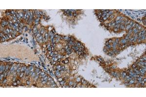 Immunohistochemistry of paraffin-embedded Human colon cancer using NDUFA9 Polyclonal Antibody at dilution of 1:30 (NDUFA9 antibody)