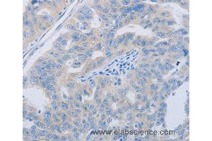 Immunohistochemistry of Human ovarian cancer using PAWR Polyclonal Antibody at dilution of 1:60