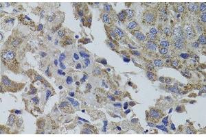 Immunohistochemistry of paraffin-embedded Human breast cancer using GNA15 Polyclonal Antibody at dilution of 1:100 (40x lens). (GNA15 antibody)
