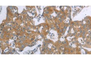Immunohistochemistry of paraffin-embedded Human breast cancer using TNK2 Polyclonal Antibody at dilution of 1:70 (TNK2 antibody)