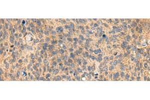 Immunohistochemistry of paraffin-embedded Human cervical cancer tissue using MIA Polyclonal Antibody at dilution of 1:100(x200) (MIA antibody)