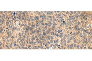Immunohistochemistry of paraffin-embedded Human cervical cancer tissue using MIA Polyclonal Antibody at dilution of 1:100(x200)