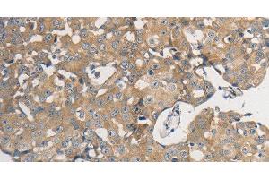 Immunohistochemistry of paraffin-embedded Human breast cancer using PPP2CB Polyclonal Antibody at dilution of 1:50 (PPP2CB antibody)